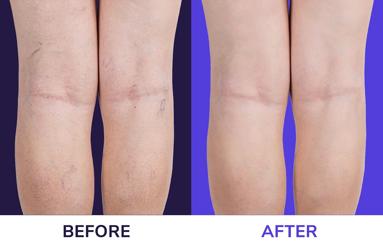 Varicose Veins Before And After