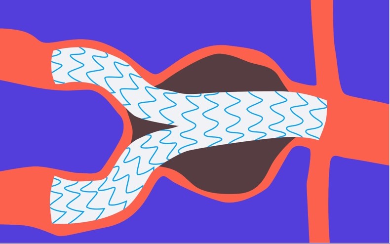 Aortic Aneurysm Repair