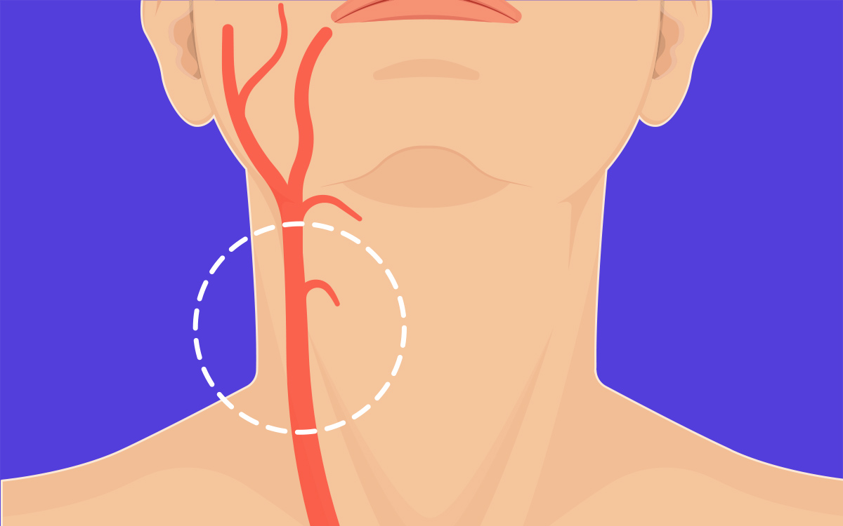 Carotid Surgery For Stroke Prevention