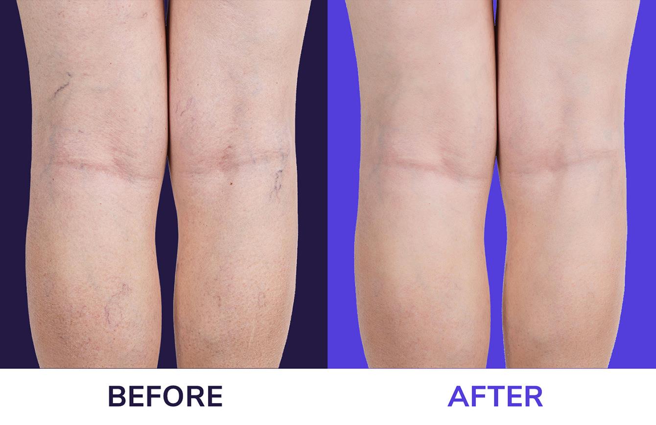 Varicose Veins Before And After